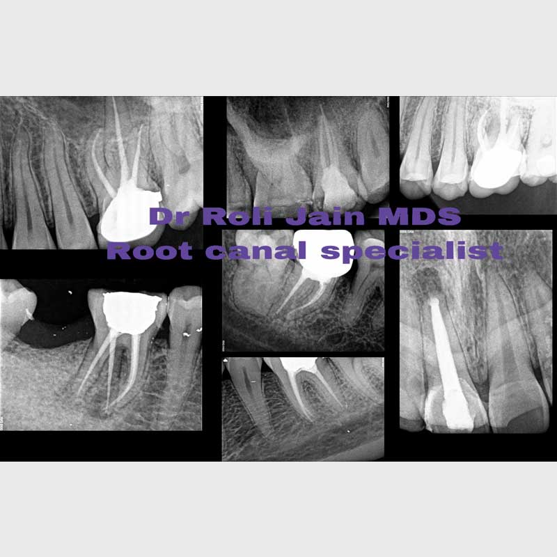 Root Canal Treatment