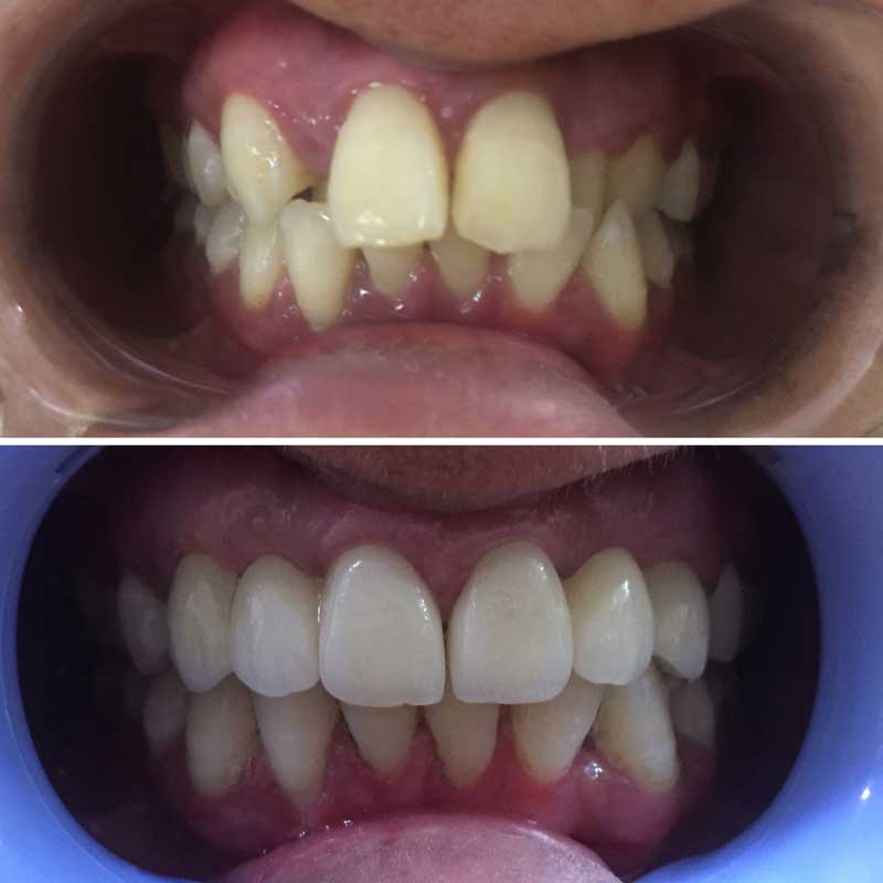 Teeth Whitening