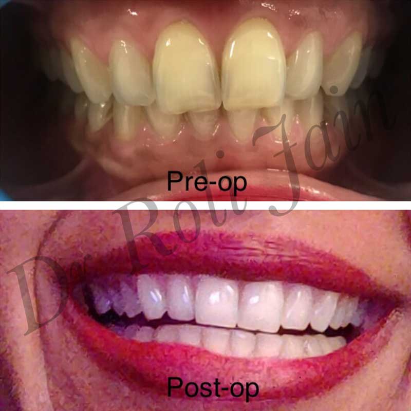 Teeth Whitening