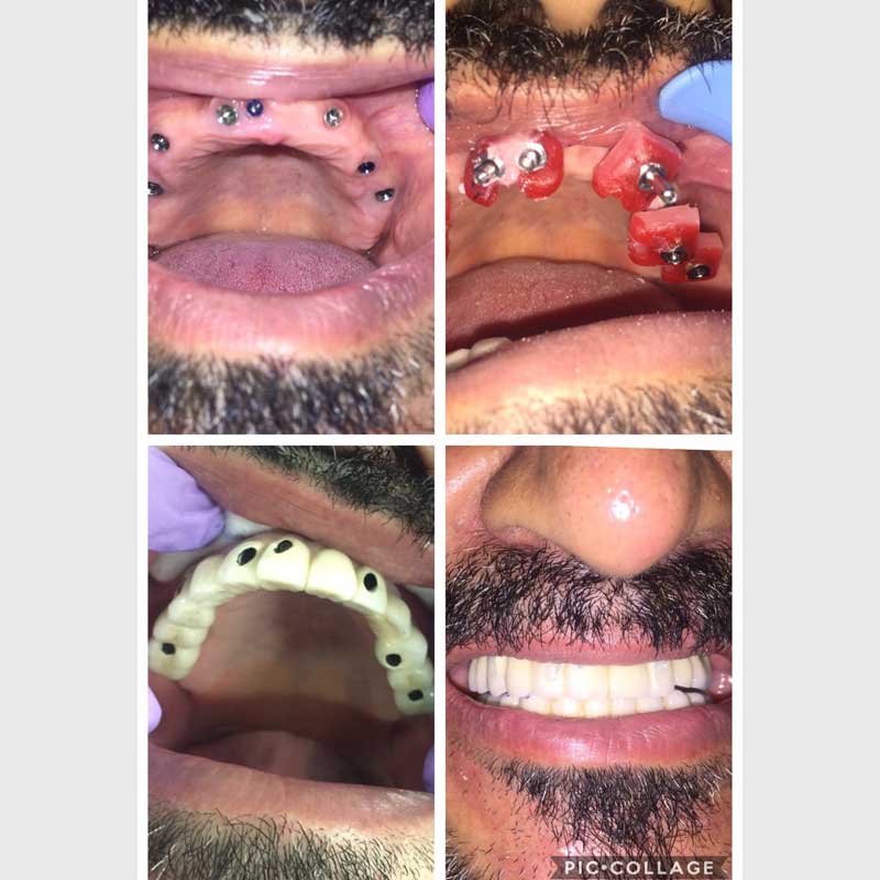Dental Implant&nbsp;&nbsp;&nbsp;&nbsp;