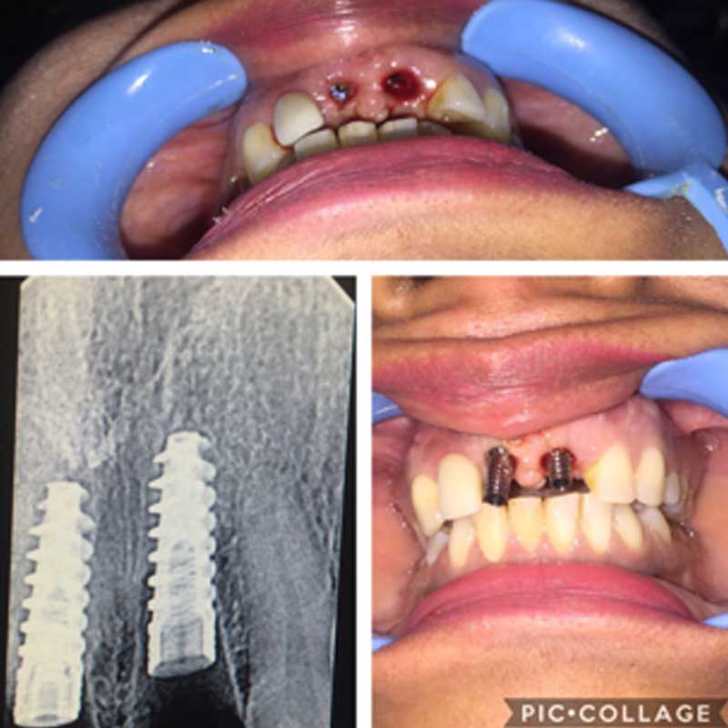 Dental Implant