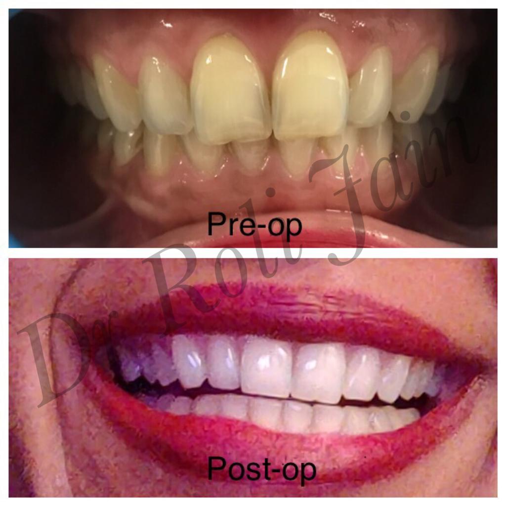 LASER BLEACHING