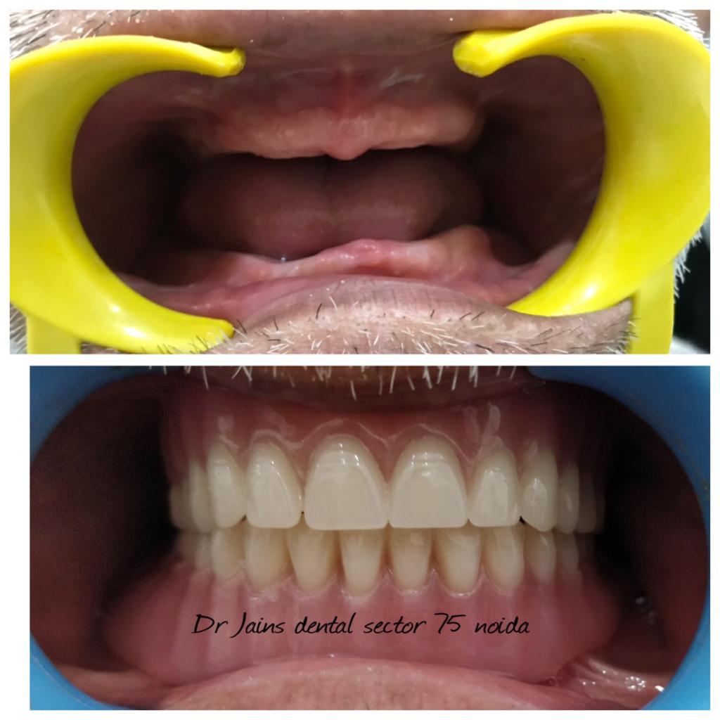 FULL&nbsp; MOUTH&nbsp; DENTURE