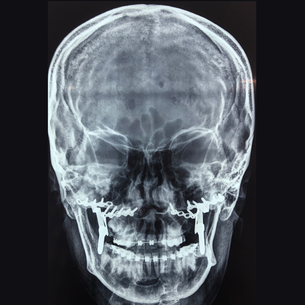 Distraction Treatment for Upper Jaw