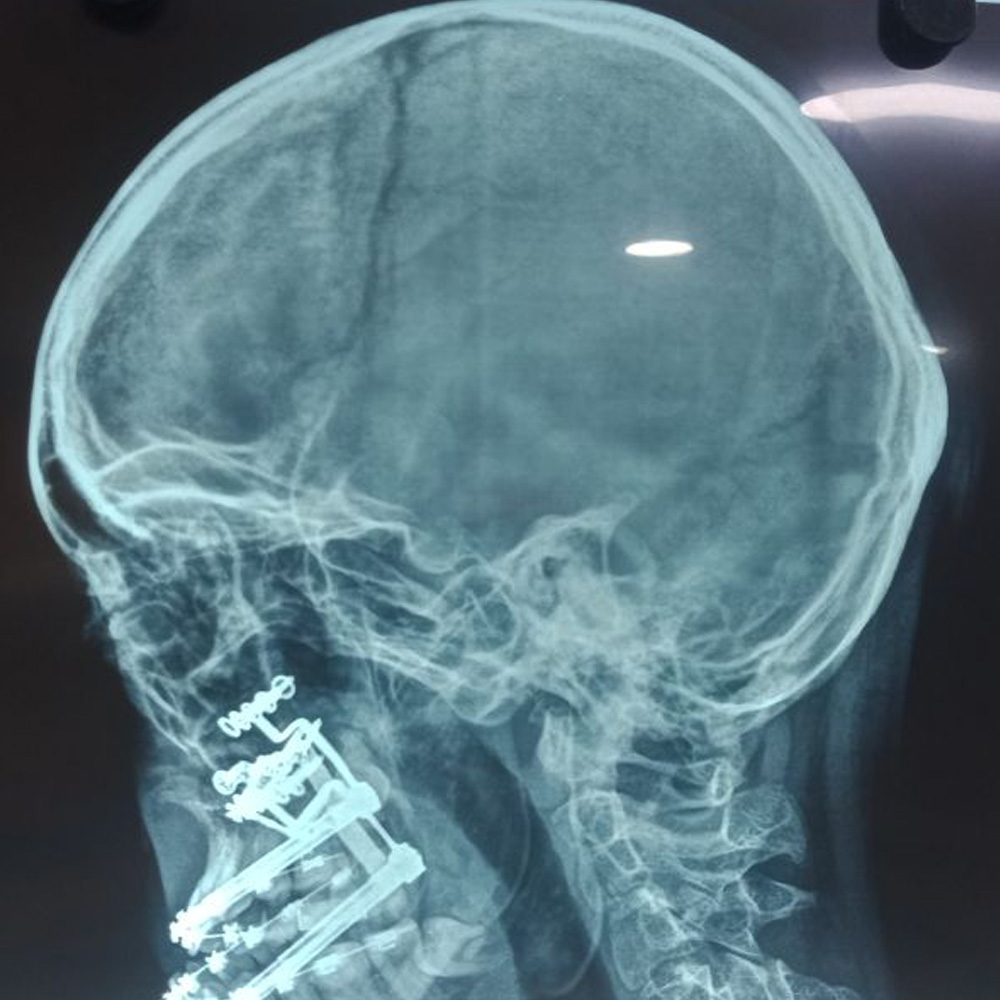 Distraction Treatment for Upper Jaw