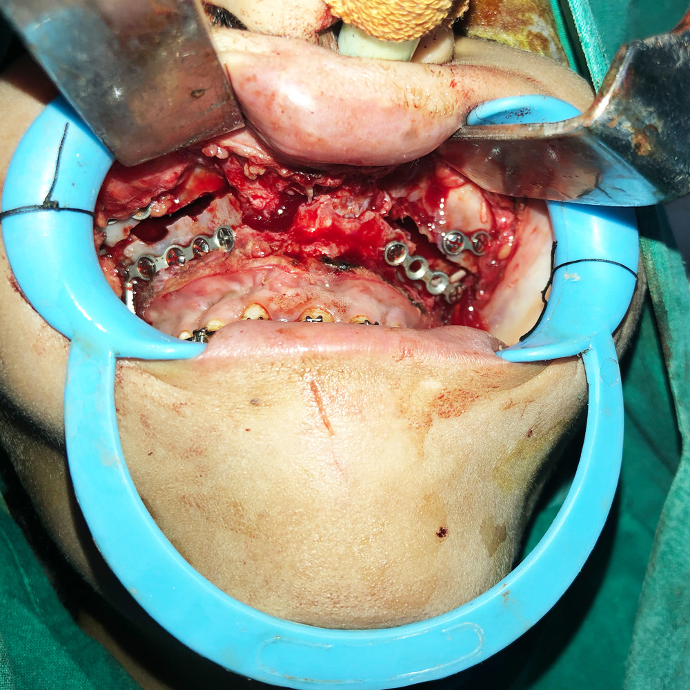 Distractors for Upper&nbsp;Jaw