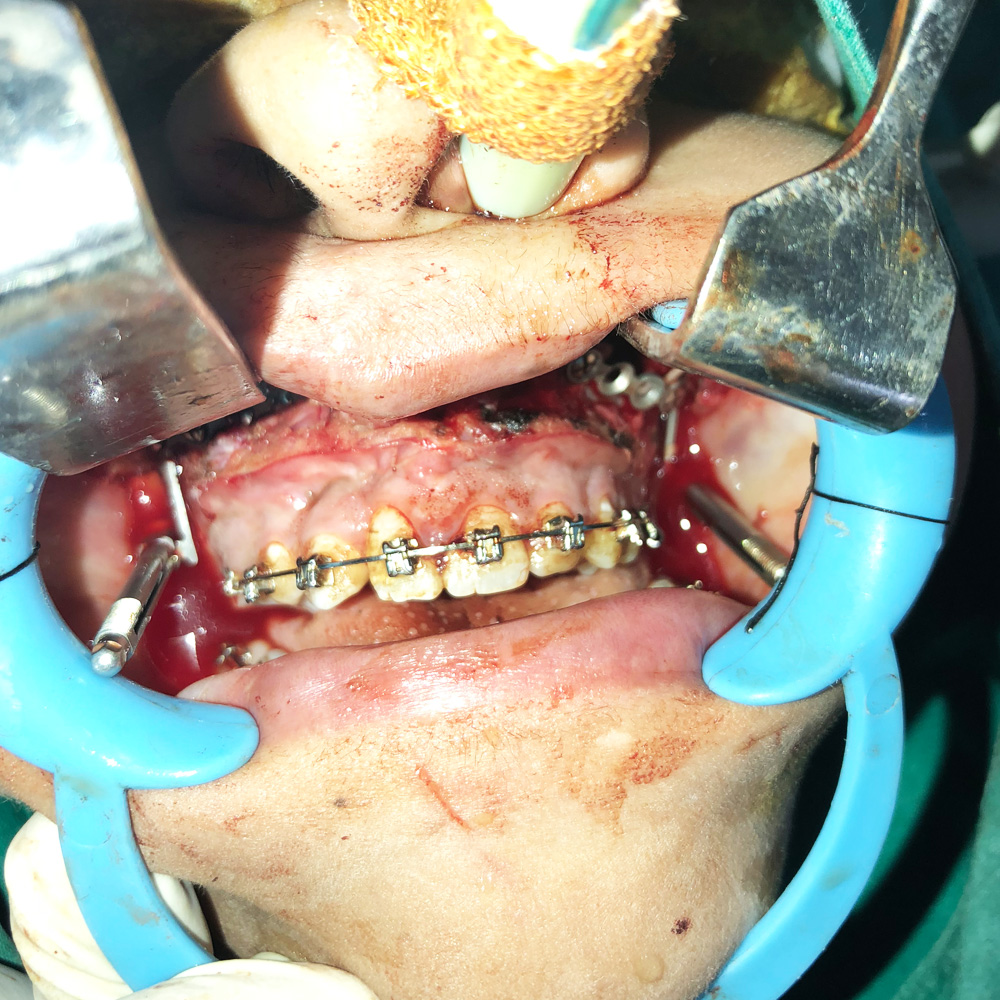 Distractors for Upper&nbsp;Jaw