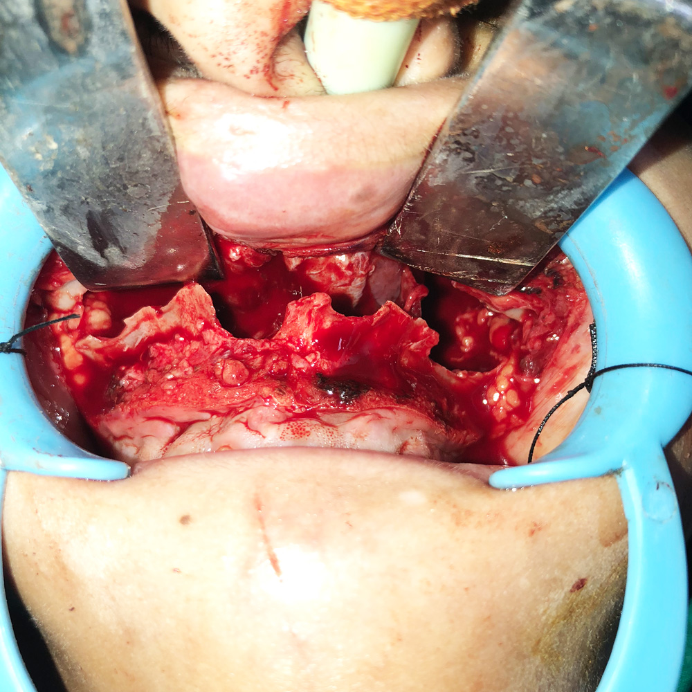 Distractors for Upper&nbsp;Jaw