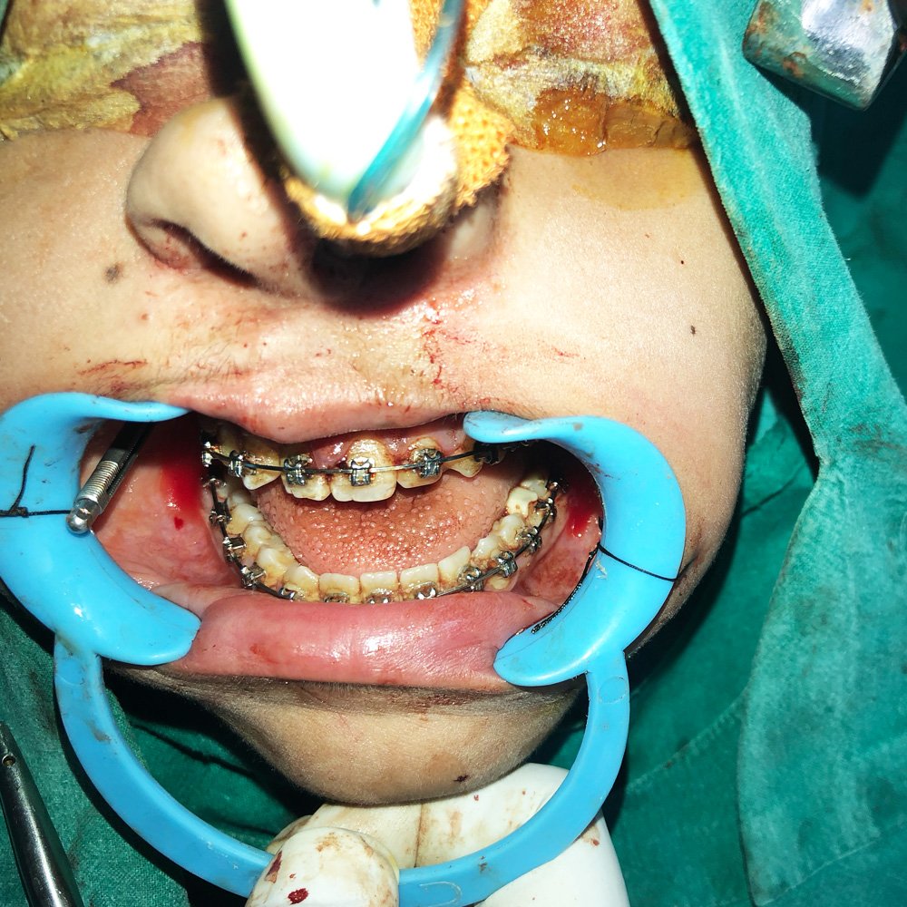 Distractors for Upper&nbsp;Jaw