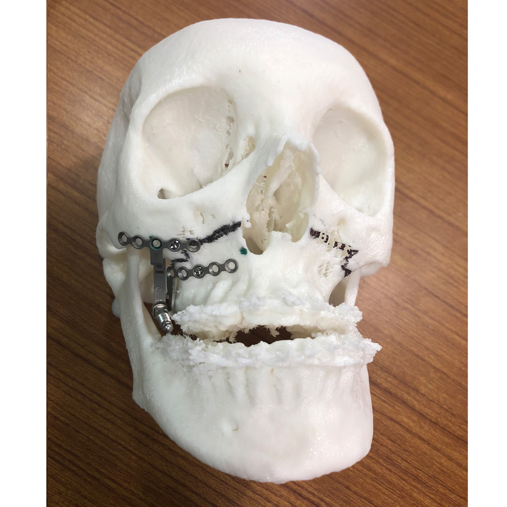 Distractors on STL Model