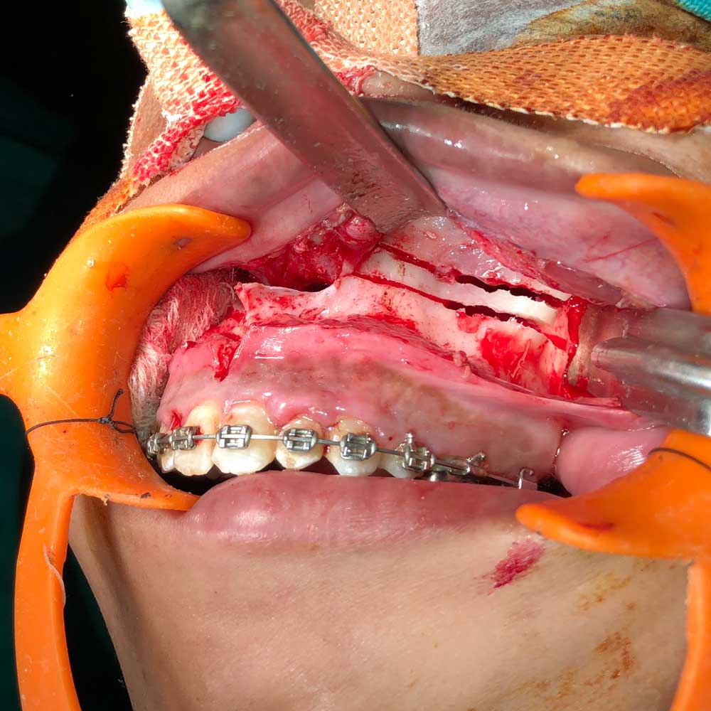 Jaw Corrective Surgery (Orthognathic)