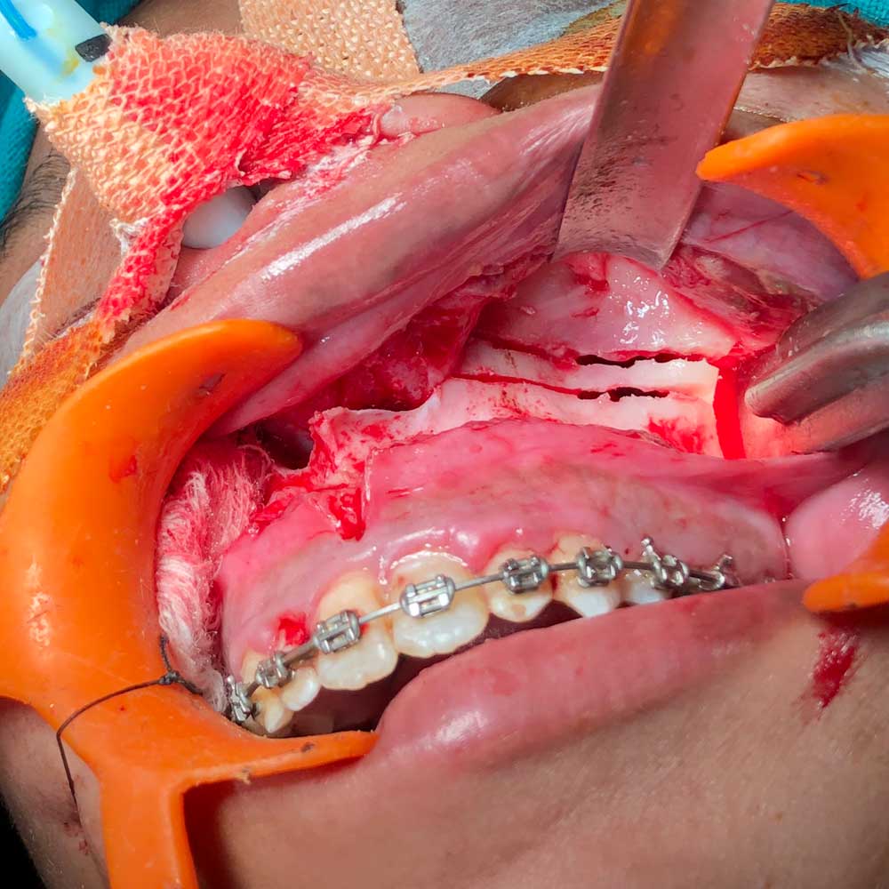 Jaw Corrective Surgery (Orthognathic)
