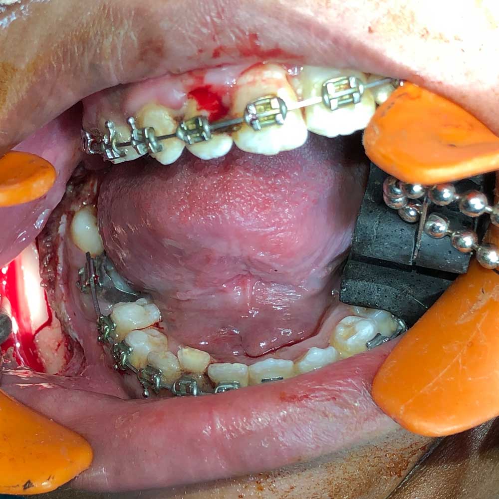 Jaw Corrective Surgery (Orthognathic)