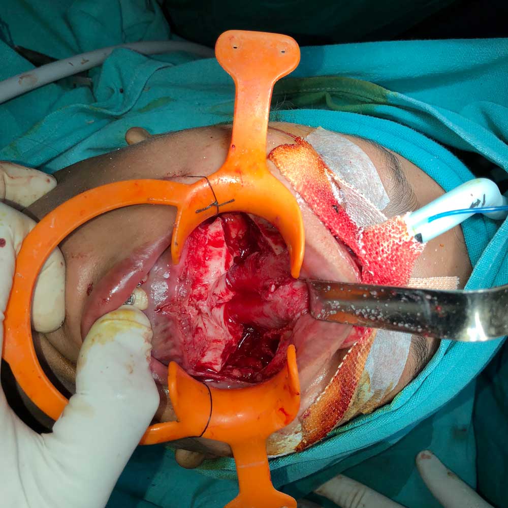 Jaw Corrective Surgery (Orthognathic)