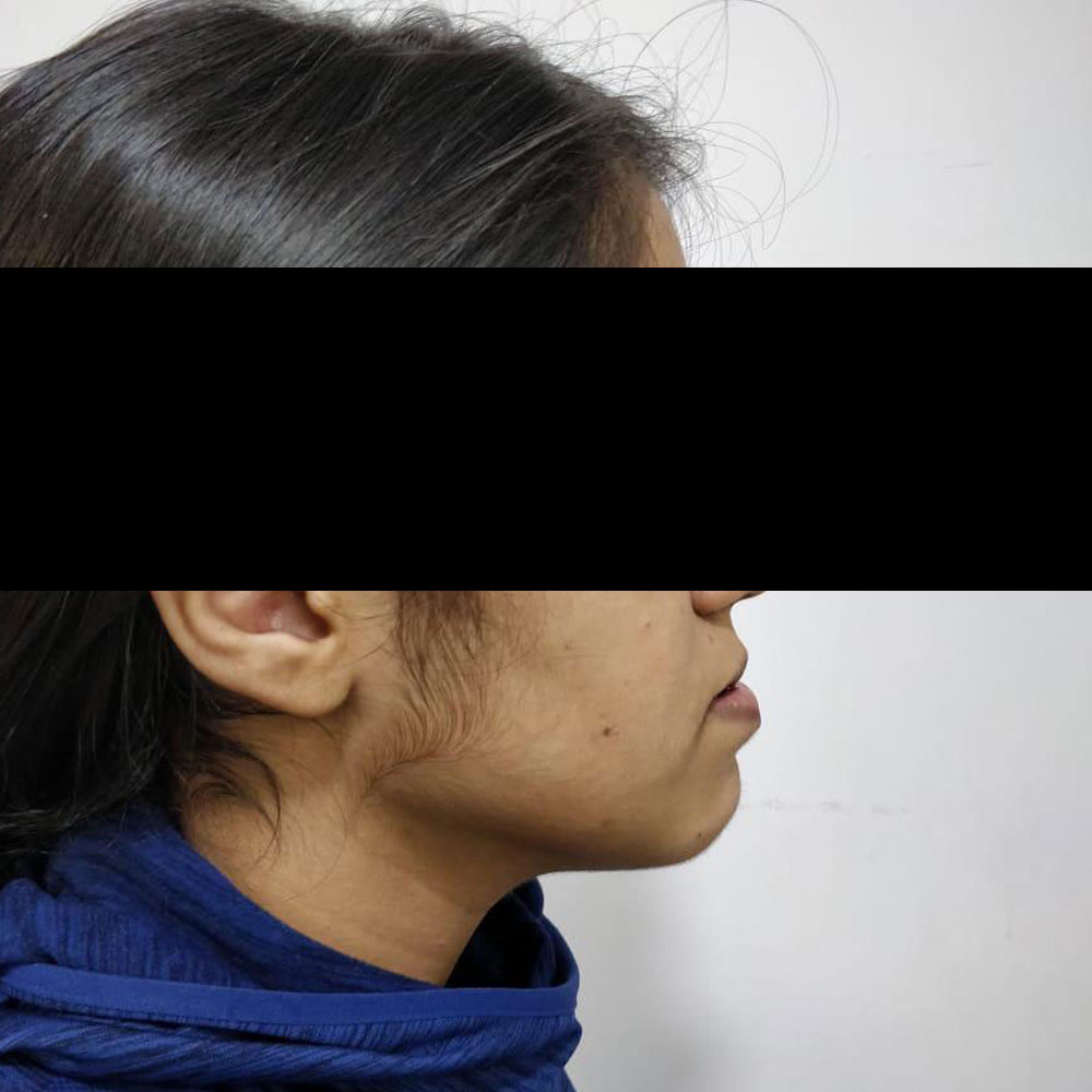 Facial Jaw Corrective Surgery