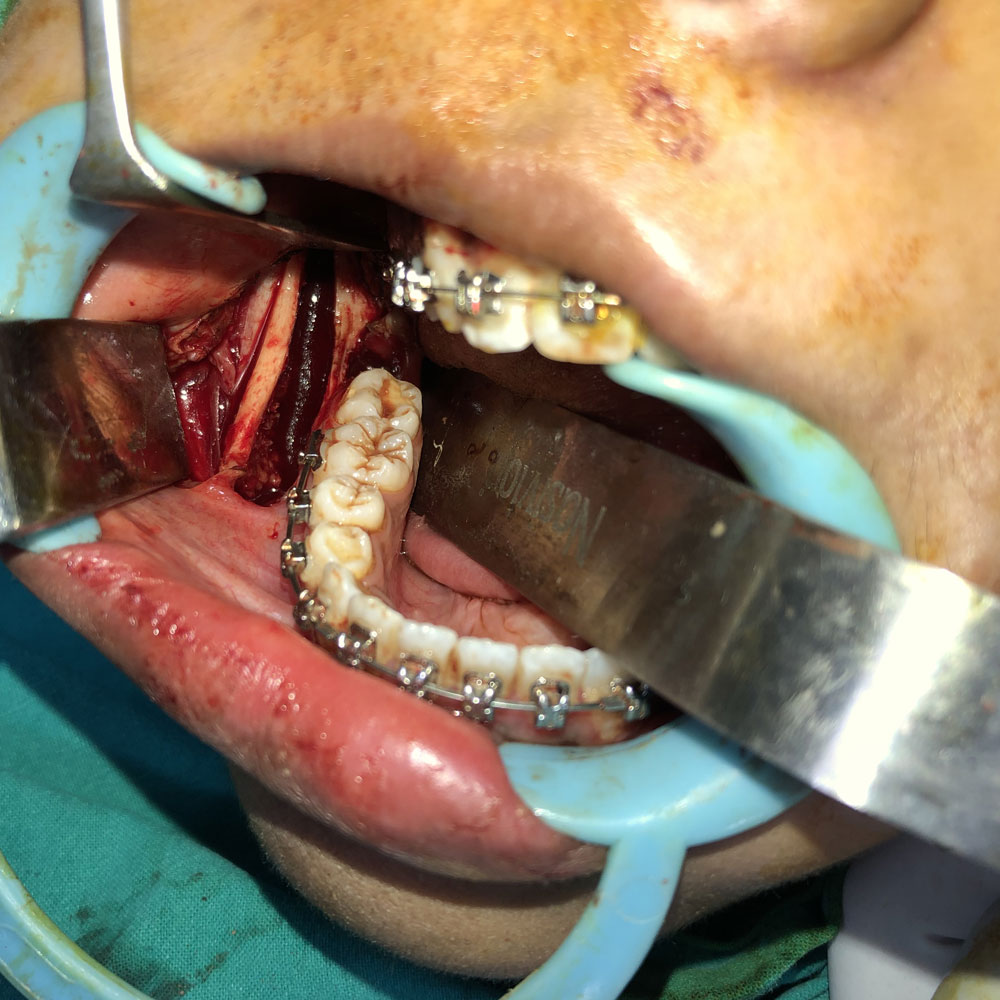 Facial Jaw Corrective Surgery