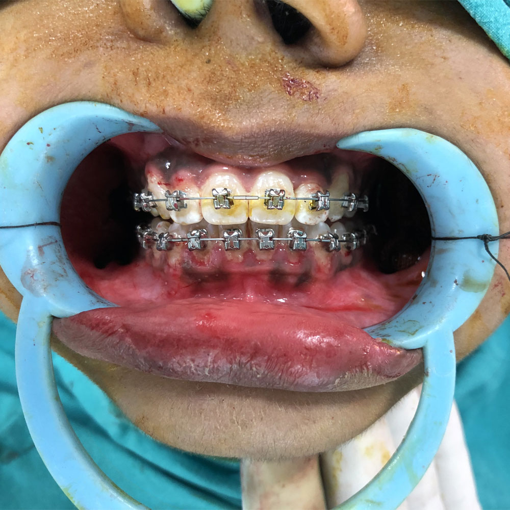 Facial Jaw Corrective Surgery