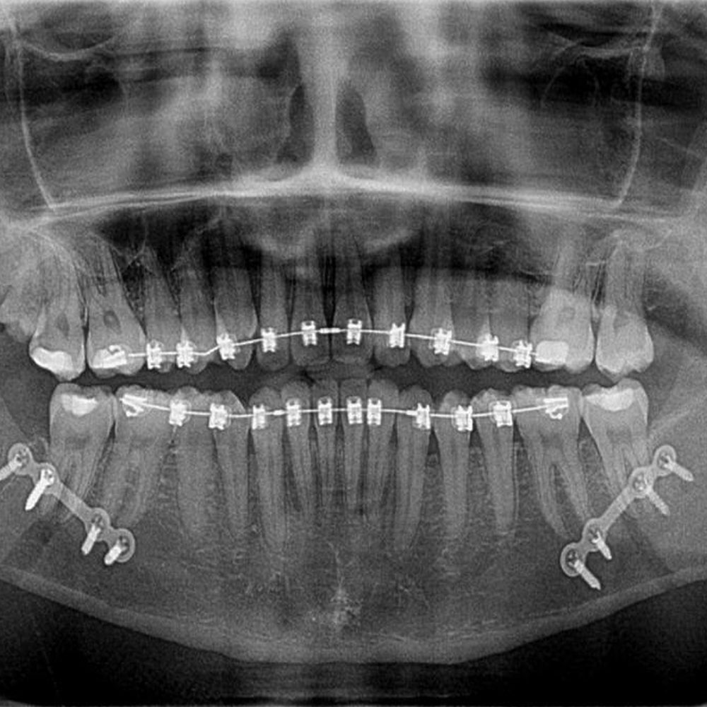 Facial Jaw Corrective Surgery