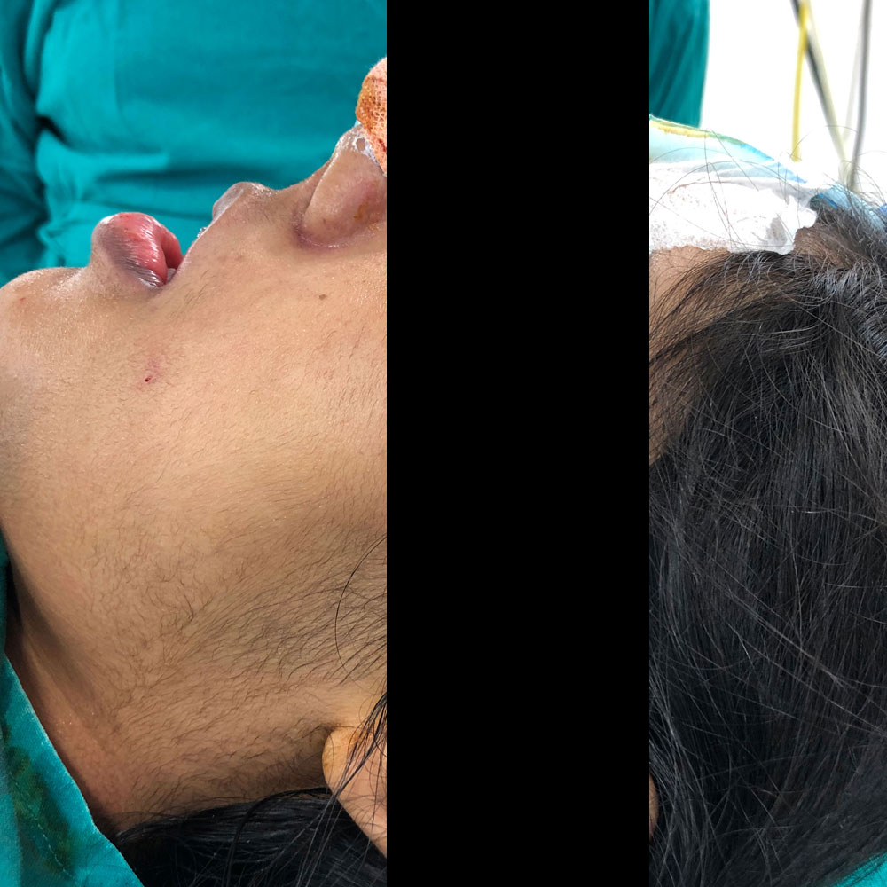 Facial Jaw Corrective Surgery
