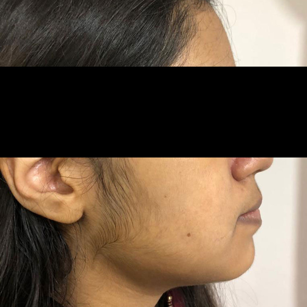 Facial Jaw Corrective Surgery