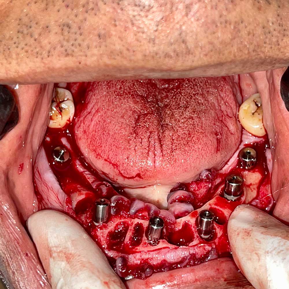 Full Mouth Implants