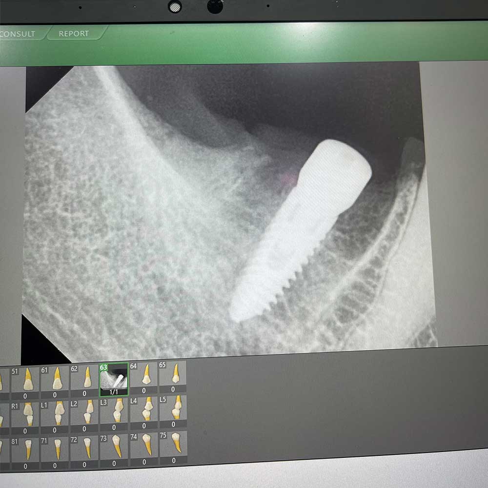 Full Mouth Implants