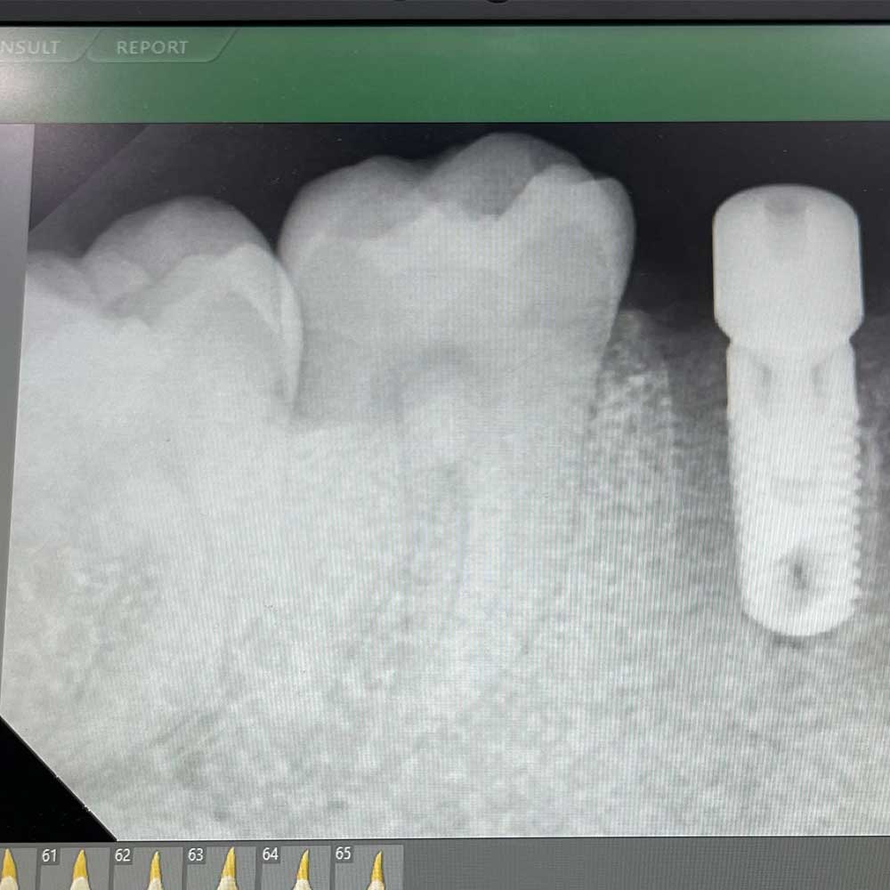 Full Mouth Implants