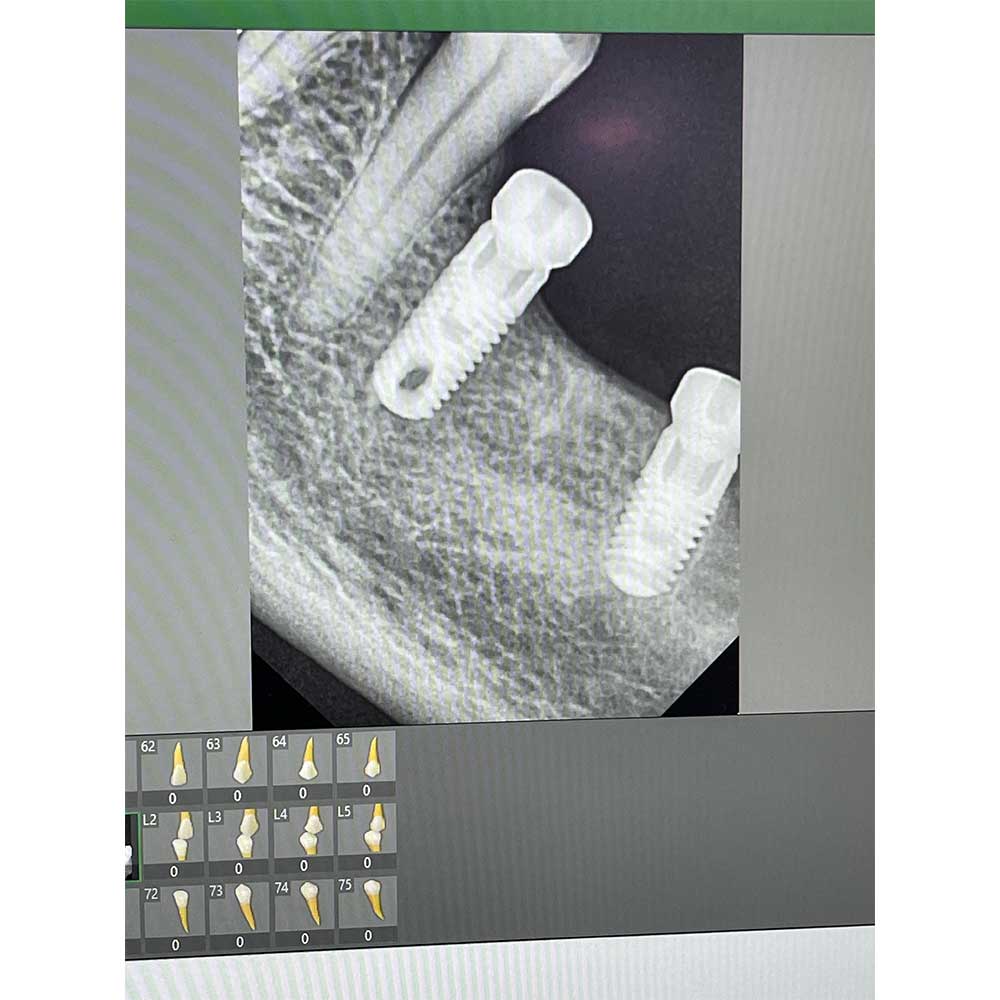 Dental Implants