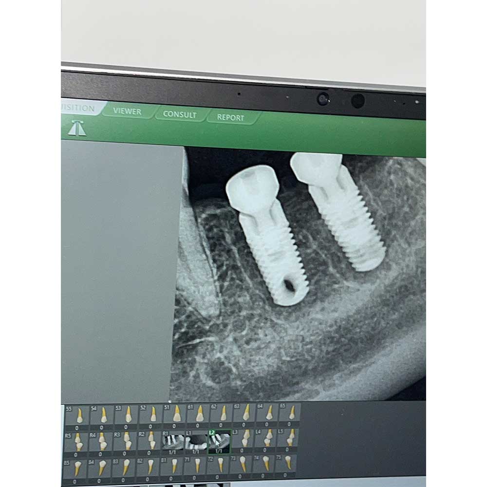 Dental Implants