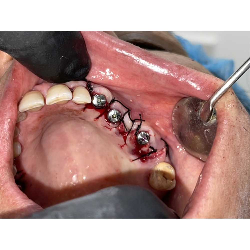 Dental Implants