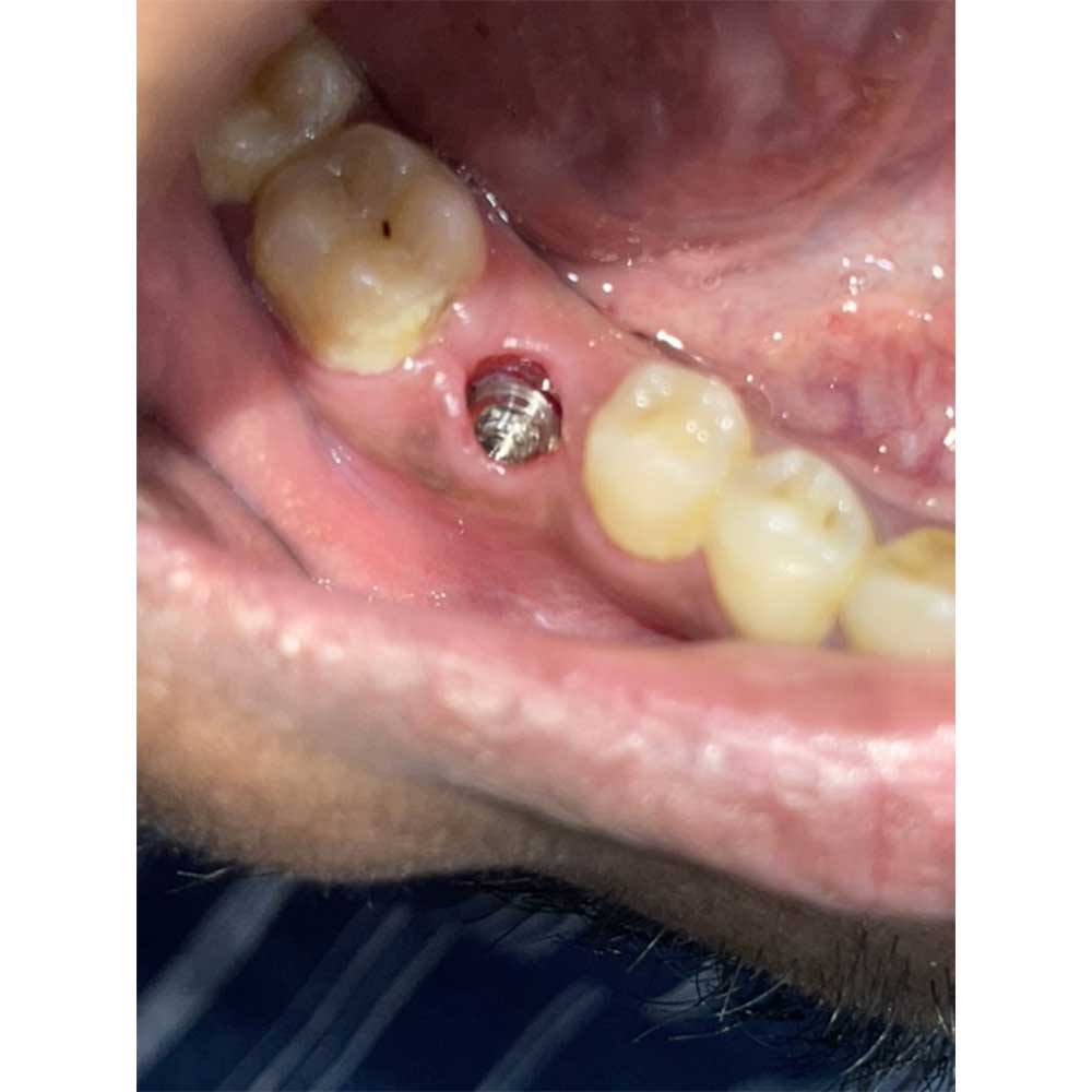 Dental Implants