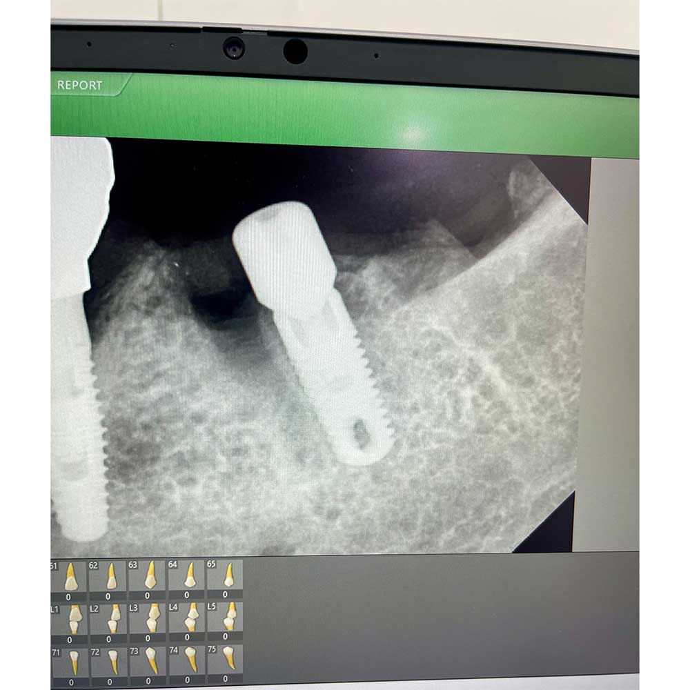 Dental Implant