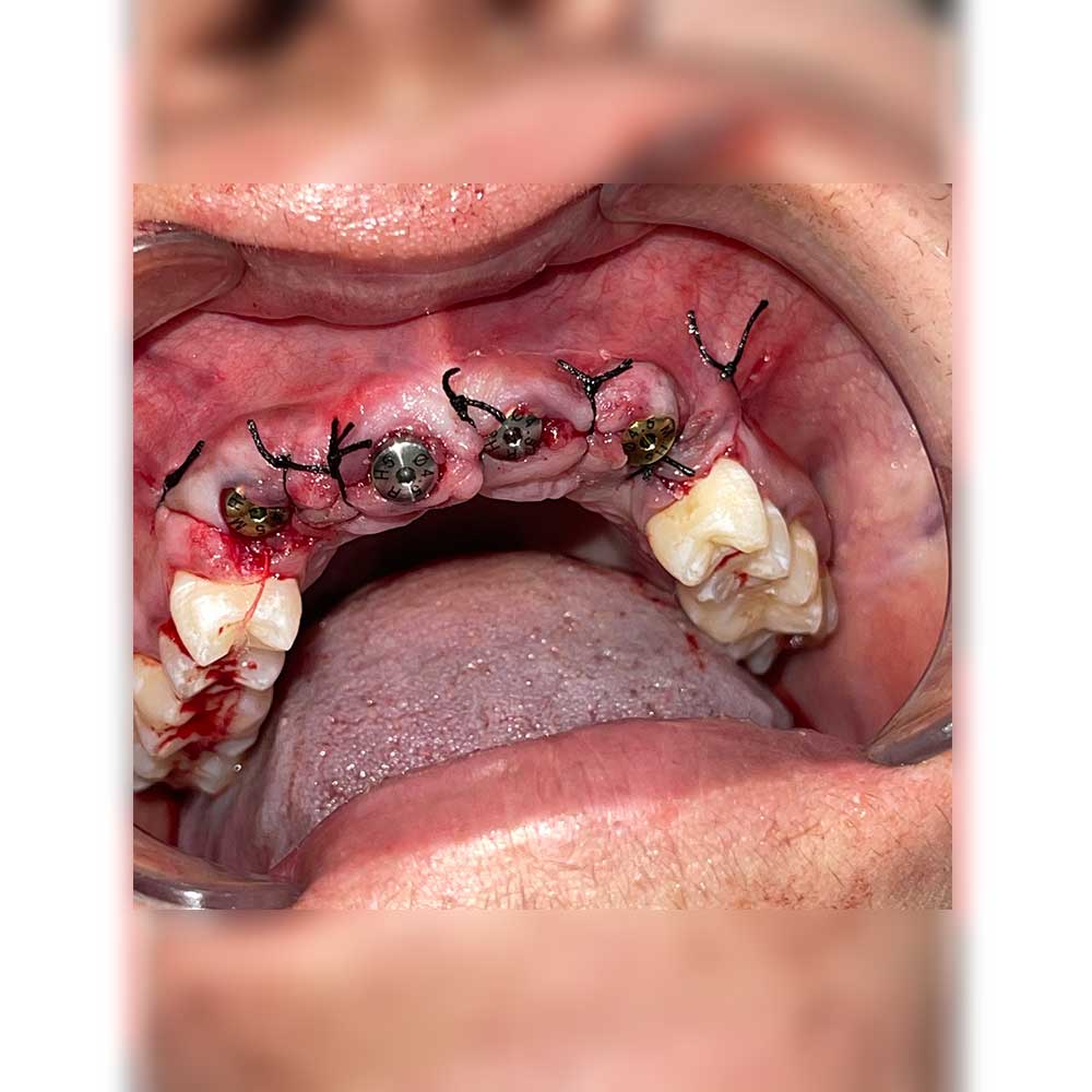 Dental Implant
