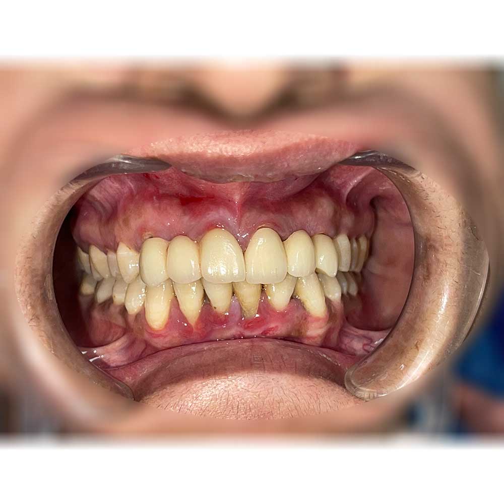 Dental Implant