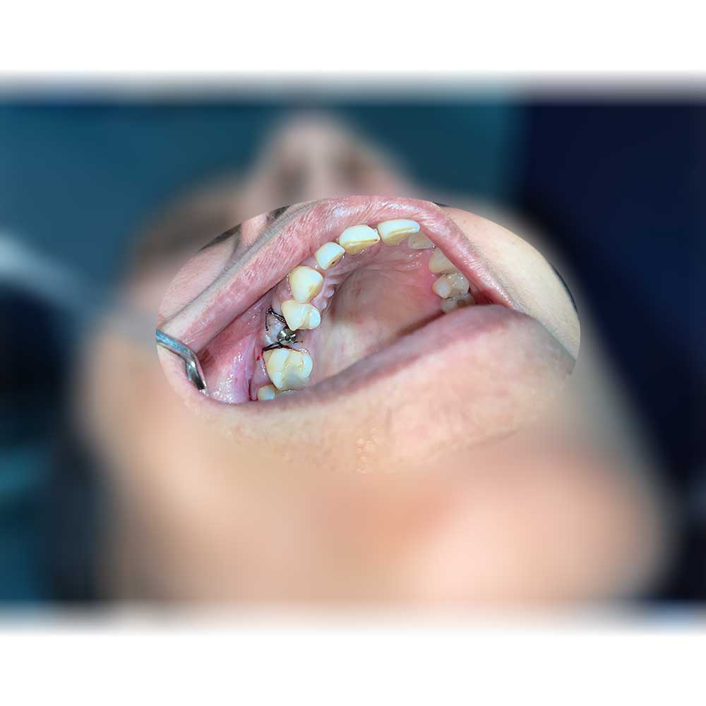 Dental Implant