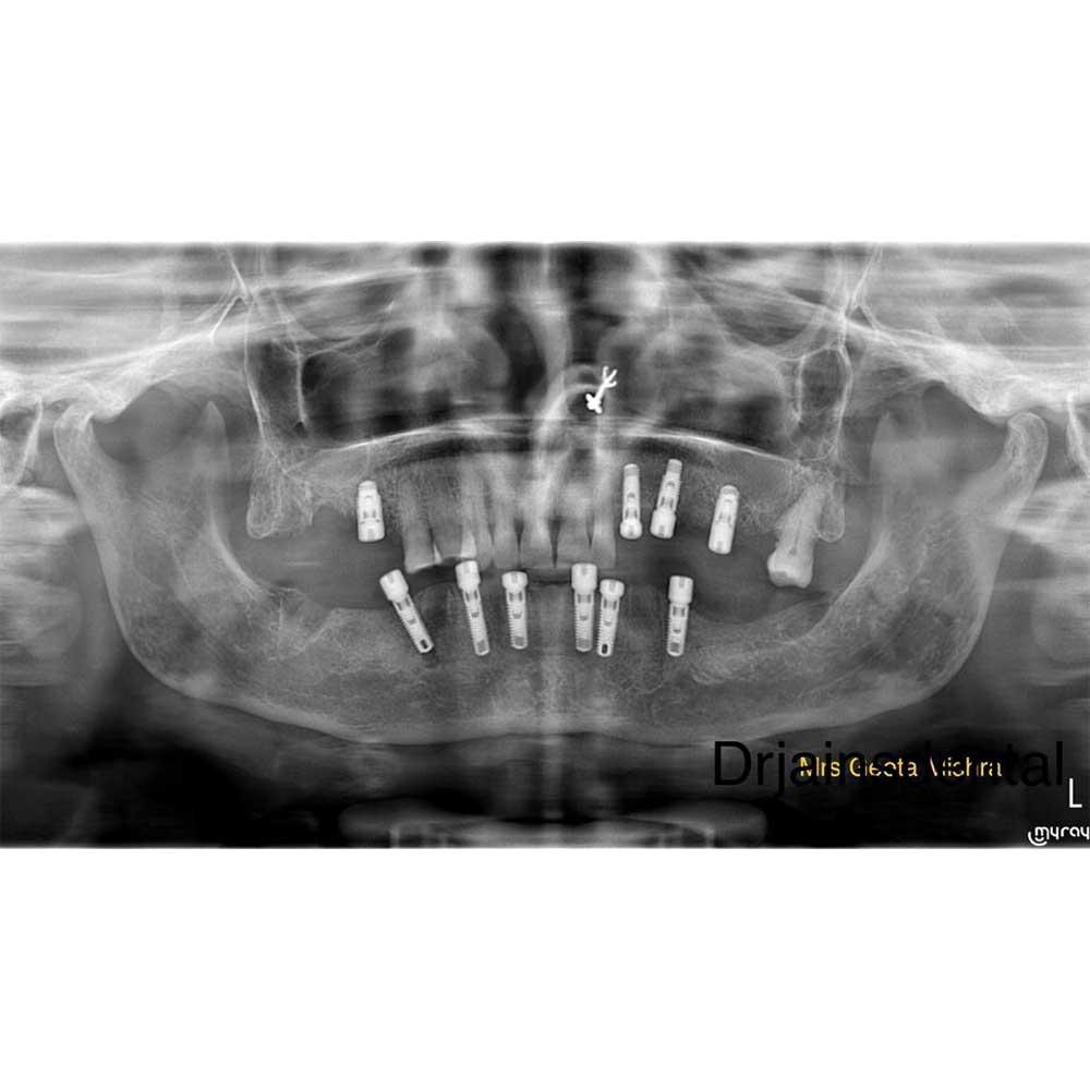 Dental Implant