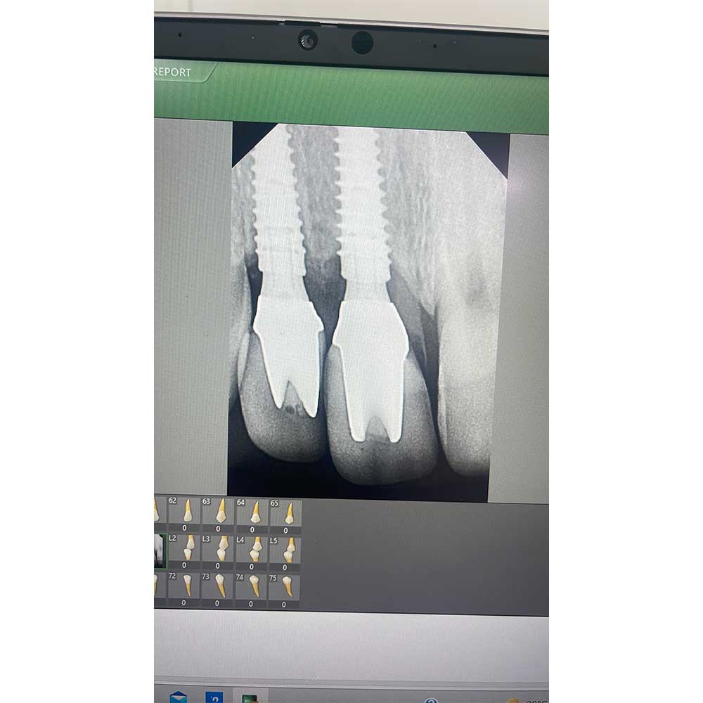 Dental Implant