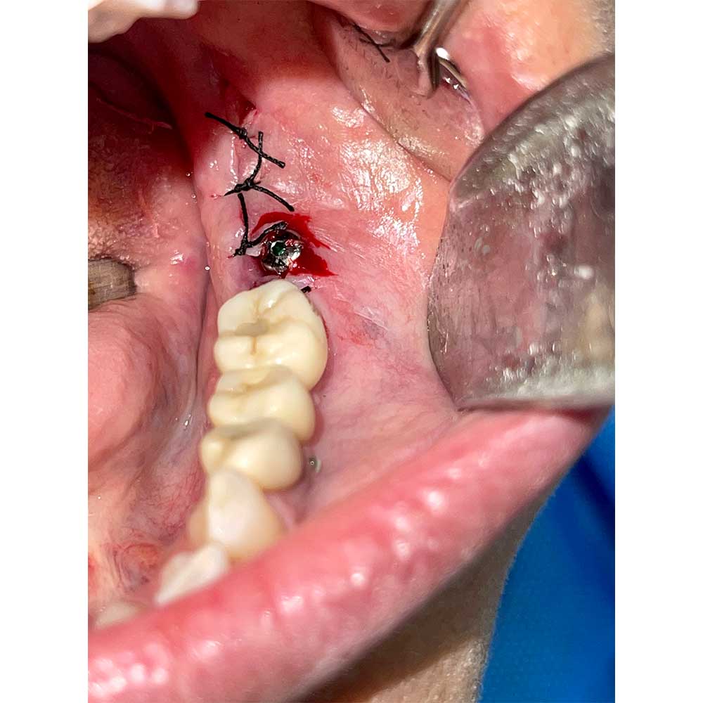 Dental Implant