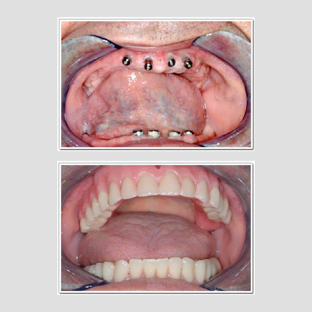 DENTAL IMPANTS