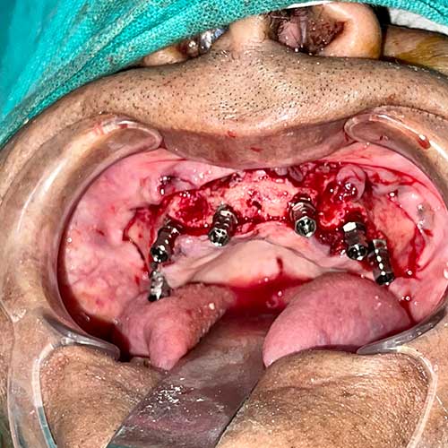 Dental Implants