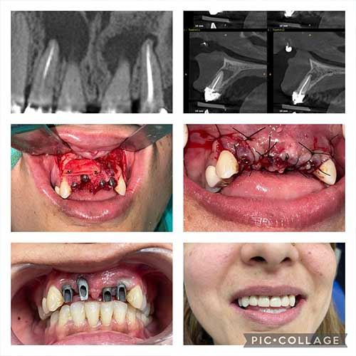 Dental Implants
