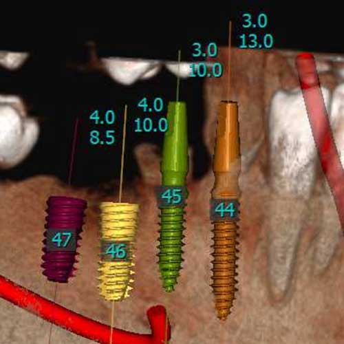 Dental Implants
