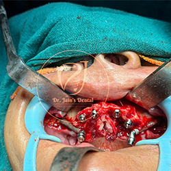 Zygomatic Implants 