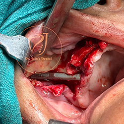 Zygomatic Implants 