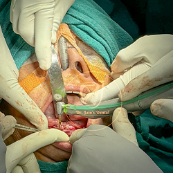 Zygomatic Implants 
