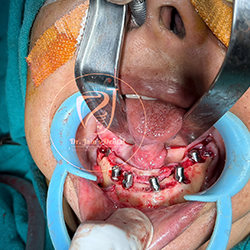 Zygomatic Implants 