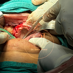 Zygomatic Implants 