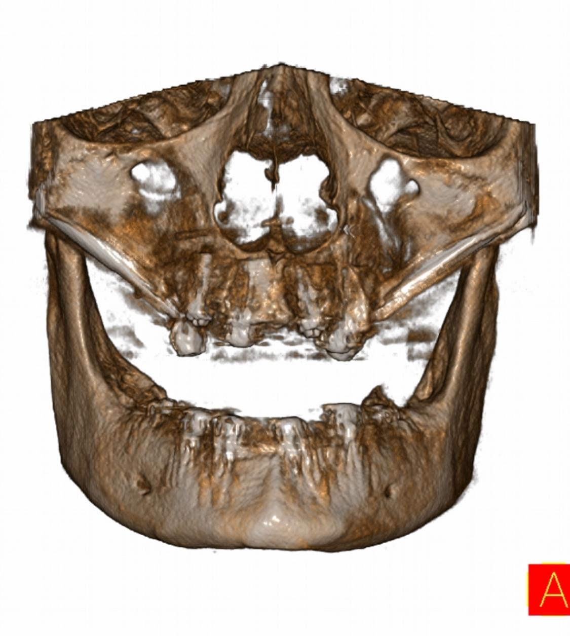 Zygomatic Implants 