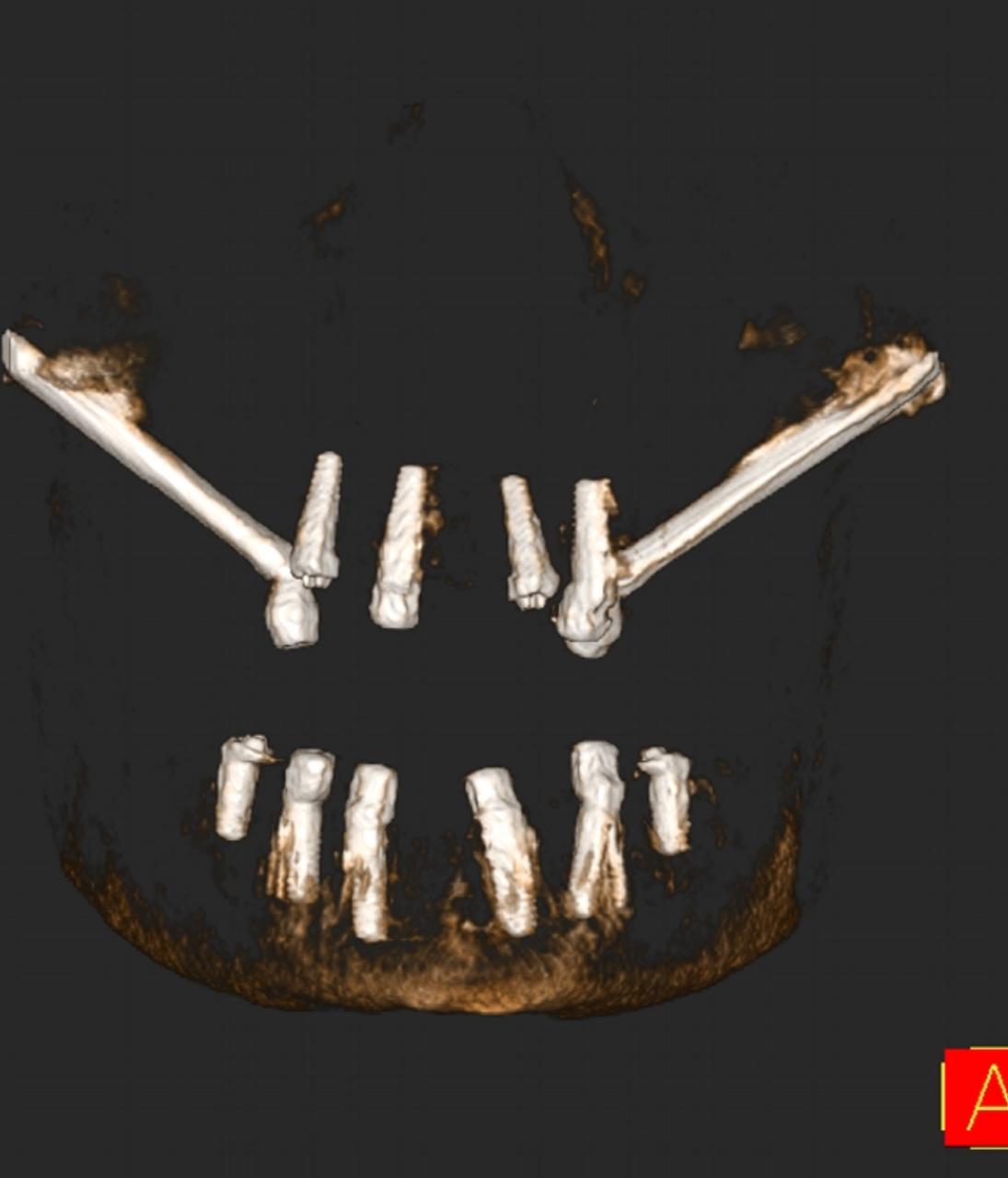 Zygomatic Implants 