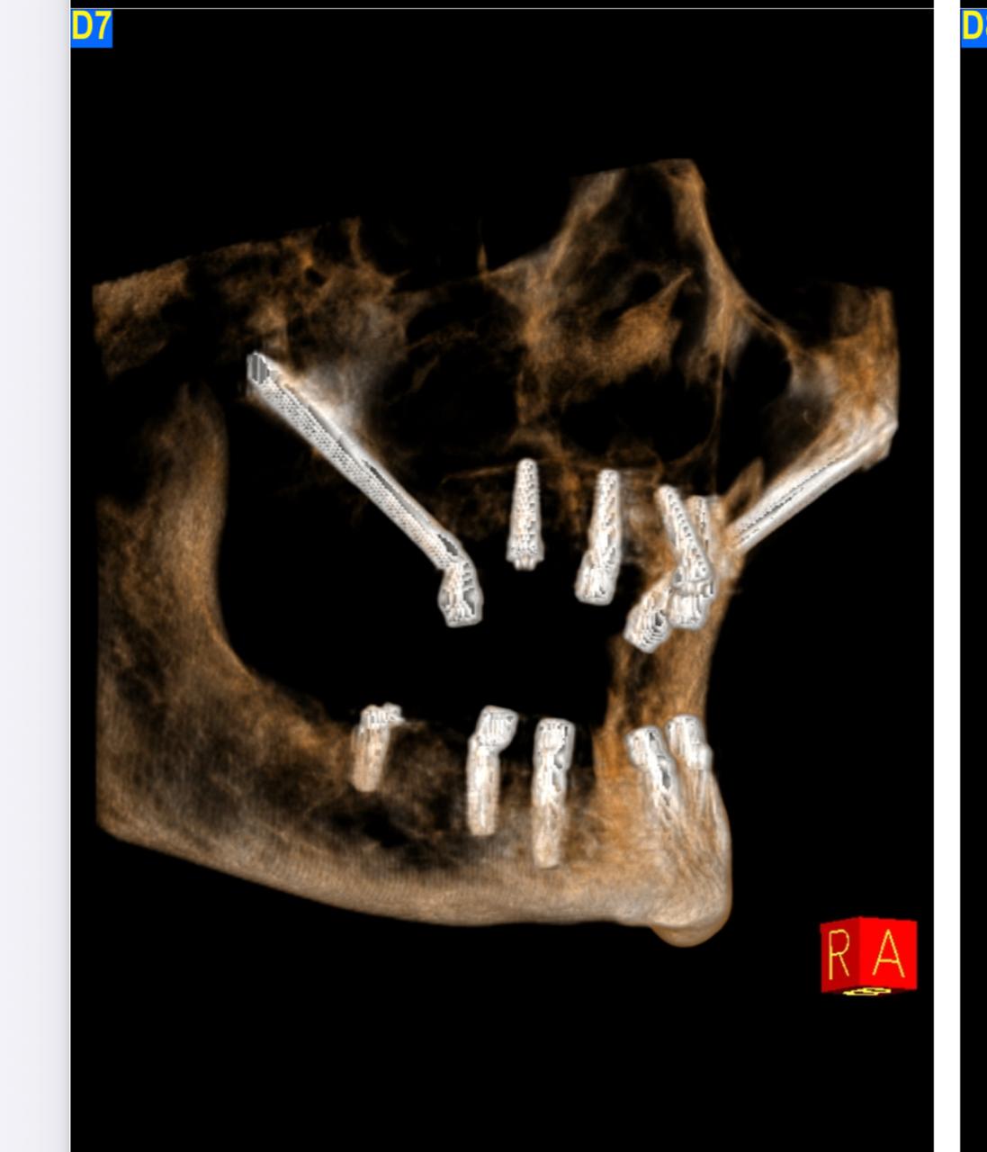 Zygomatic Implants 